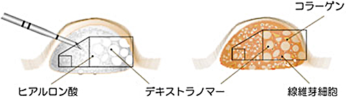 Deflux®注入療法