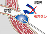 Deflux<sup>®</sup>注入療法