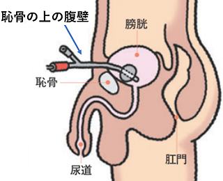 膀胱ろう(男性)