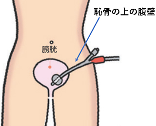 膀胱ろう(女性)