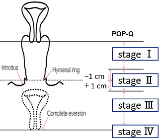 POP-Q stage分類(最下端の部位で評価)