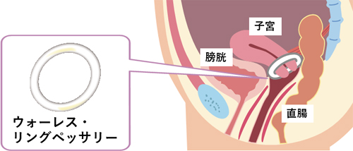 Deflux®注入療法
