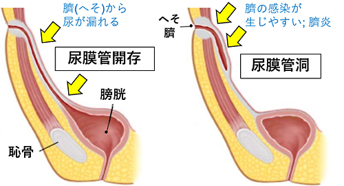 Blichert-Toft の分類