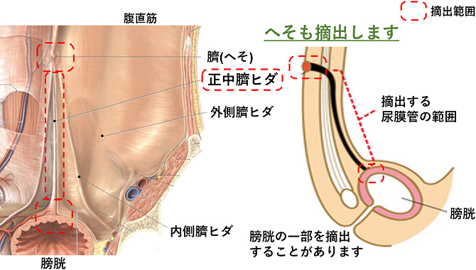 尿膜管遺残症の手術での摘出範囲