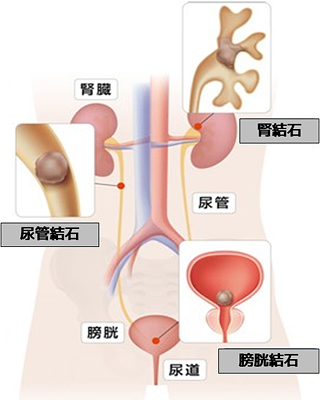 結石のできる位置とその名称