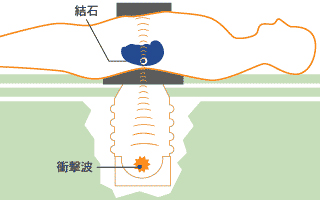 体外衝撃波のイメージ