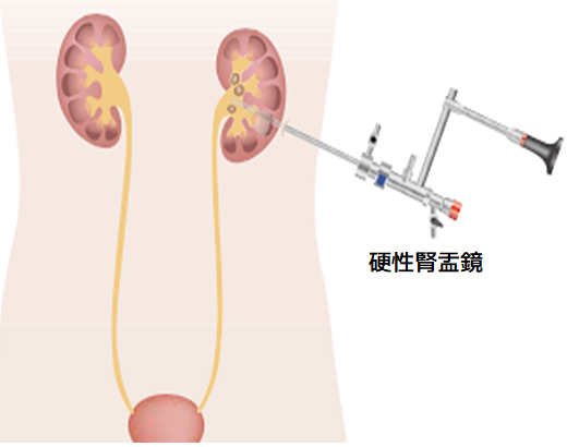 軟性尿管鏡を用いた内視鏡手術のイメージ
