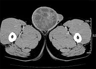 CT(右精巣腫瘍)