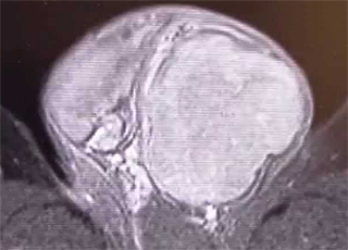 MRI(左精巣腫瘍)