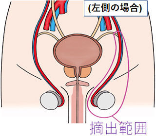 高位精巣摘除術の範囲