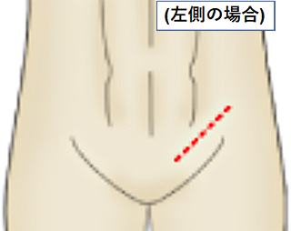 皮膚切開の部位