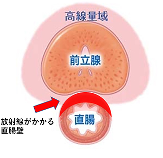SpaceOAR<sup>®</sup>システム留置なし
