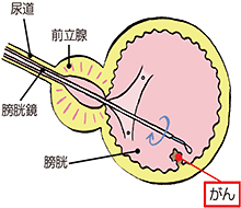 表在性がん（筋層非浸潤性膀胱がん）