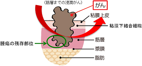 浸潤性がん
