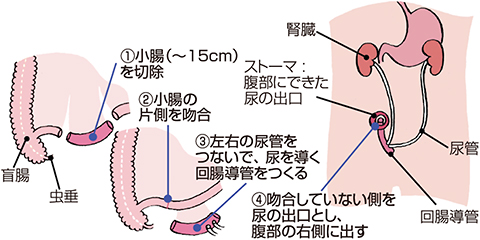 回腸導管造設術