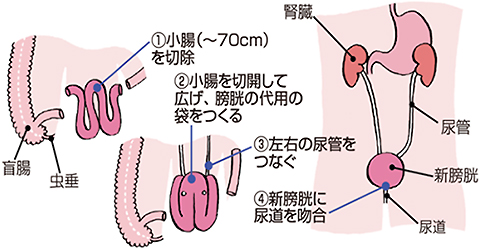 自排尿型新膀胱造設術