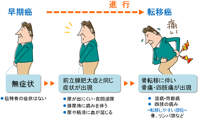 前立腺がんの症状
