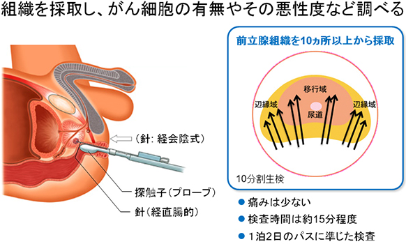 組織を採取し，がん細胞の有無やその悪性度など調べる