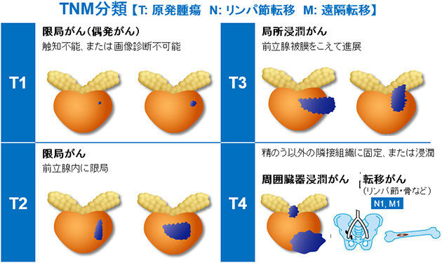 TNM分類 