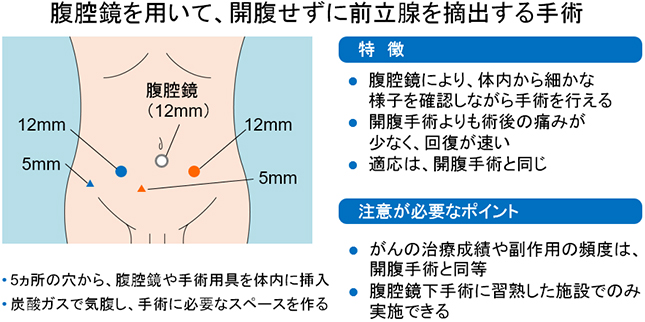腹腔鏡を用いて，開腹せずに前立腺を摘出する手術