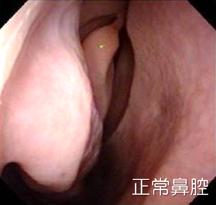 正常鼻腔