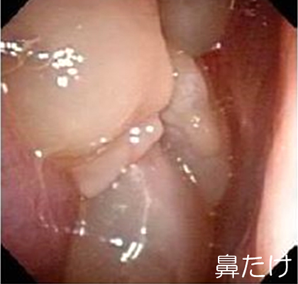 鼻たけ