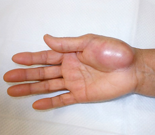 手にできた悪性腫瘍