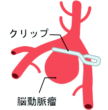 開頭クリッピング術