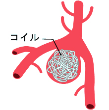 脳動脈瘤コイル塞栓術