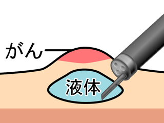 ①病変の下に生理食塩水などの薬液を注入して病変部の粘膜下層を隆起させます。