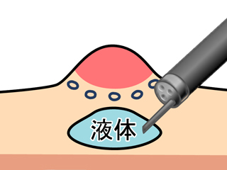 ②病変の粘膜下層に生理食塩水などの薬液を注入し，病変部を固有筋層から浮かせます。